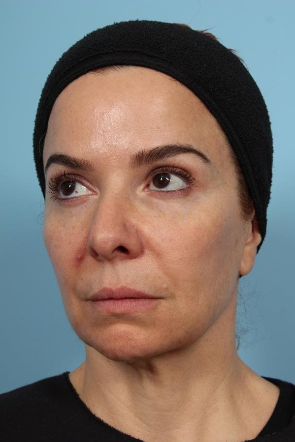 Oblique View — Before Treatment