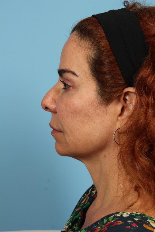 Lateral View — 16 Months Post-Treatment