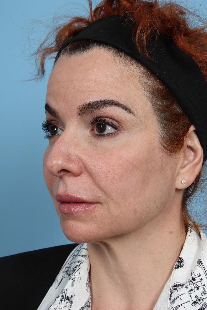 Oblique View — 2 Years Post-Treatment