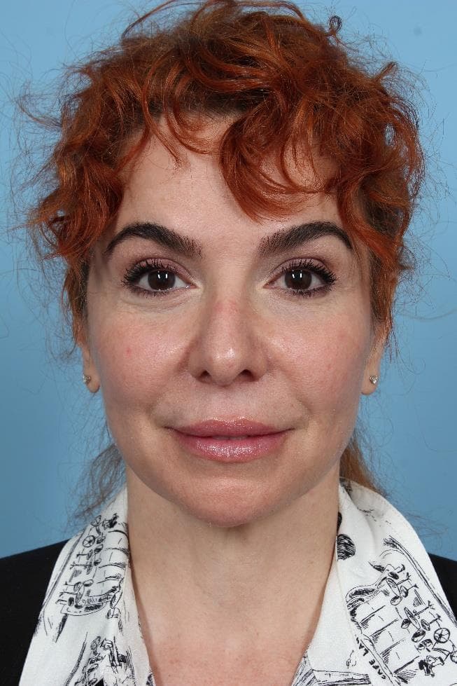 Why PDO Thread Lifts Deserve a Second Look—Especially if Filler Isn’t for You